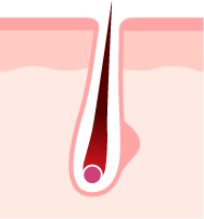 エステ脱帽のイメージ図