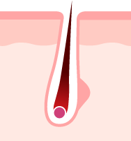 エステ脱帽のイメージ図